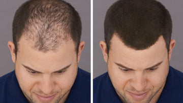 hair building fibers for thinning hair